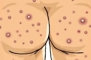 Cara Menghilangkan Bintik Bintik Di Bokong Secara Alami